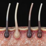 모발이식 모낭단위 비교 이미지. 하나의 모낭에 1~4개 모발이 포함된 구조를 설명