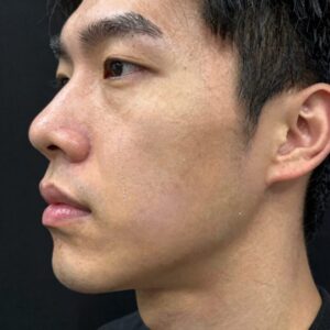 슈링크 리프팅 효과 턱선 변화 이미지