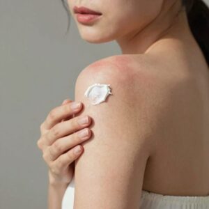 햇빛알레르기로 붉어진 피부에 진정 크림을 바르는 모습