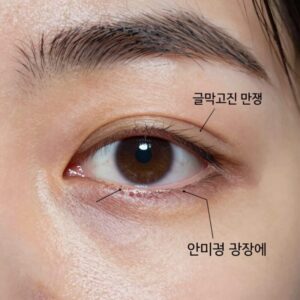 골막 고정 방식 수술 도식: 눈꼬리 인대를 분리해 안와골 골막에 고정하는 과정을 단계별로 설명