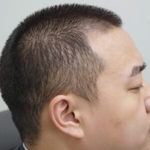 비절개모발이식 히든컷 시술 후 3개월차 이식부위 세밀 모습