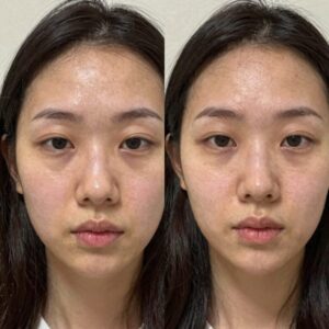리쥬란 듀얼 이펙트 앰플과 마스크 사용 전후 피부 변화 비교