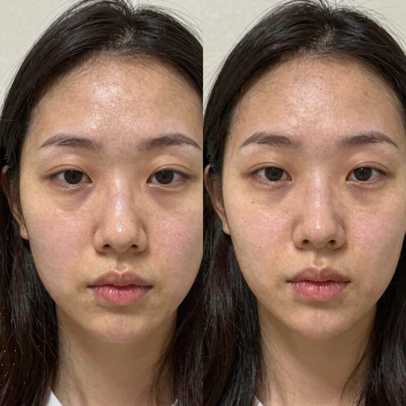 올리브영 6월 할인템 추천 1 리쥬란 듀얼 이펙트 앰플과 마스크 사용 전후 피부 변화 비교