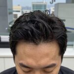 모발이식 3000모 비용 상담 시 두피 진단기로 확인하는 모낭 상태와 헤어라인 디자인