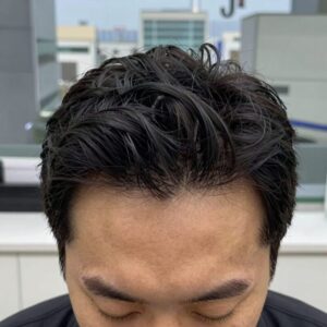 모발이식 3000모 비용 상담 시 두피 진단기로 확인하는 모낭 상태와 헤어라인 디자인