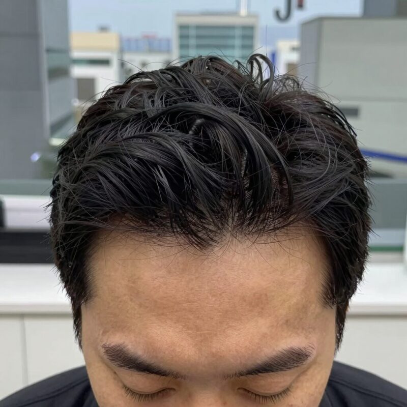 모발이식 3000모 비용 상담 시 두피 진단기로 확인하는 모낭 상태와 헤어라인 디자인