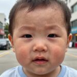 모기알러지로 눈 주변이 심하게 부은 아기 얼굴 사진, 스키터증후군 증상 예시