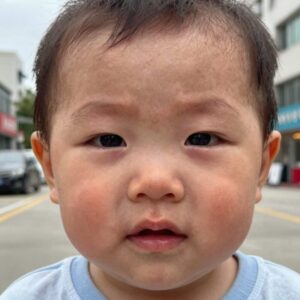 모기알러지로 눈 주변이 심하게 부은 아기 얼굴 사진, 스키터증후군 증상 예시