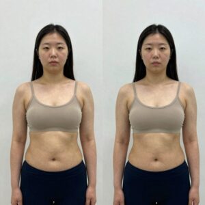 서인영 지방흡입 수술 전후 몸매 비교 이미지